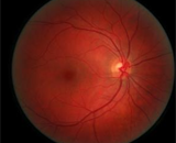 Препараты от давления помогают при диабетической ретинопатии