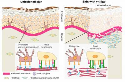 Journal of Pathology: Открыт новый метод лечения витилиго